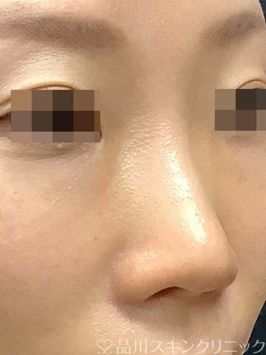 症例NO.69703のBEFORE写真