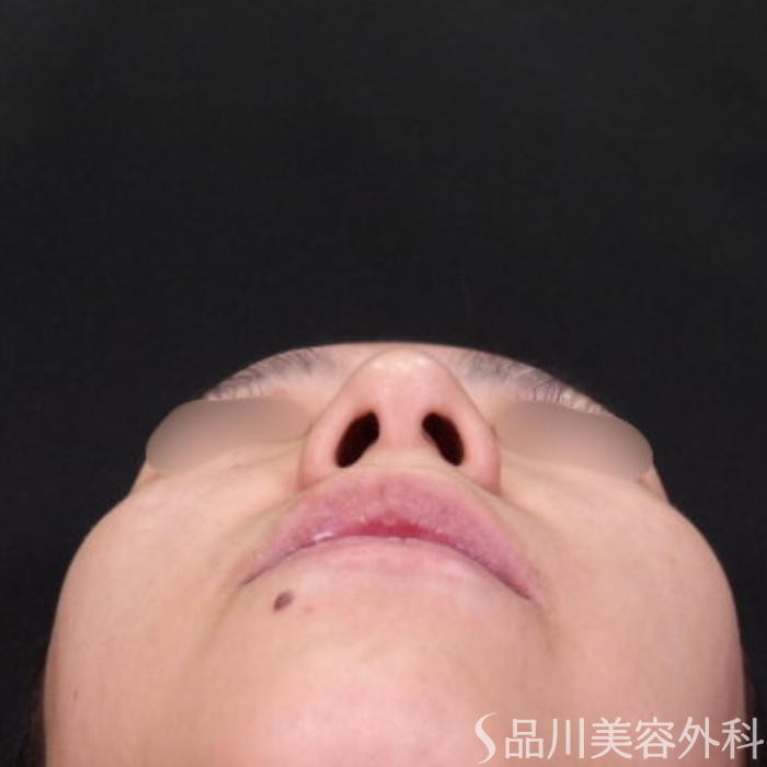 症例NO.71212のBEFORE写真