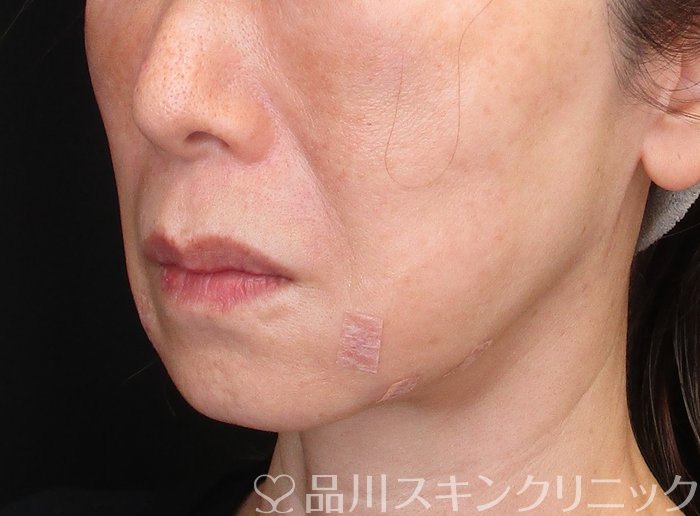 症例NO.75135のAFTER写真