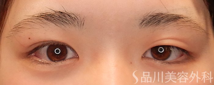 症例NO.69928のBEFORE写真