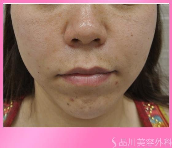 症例NO.11640のAFTER写真