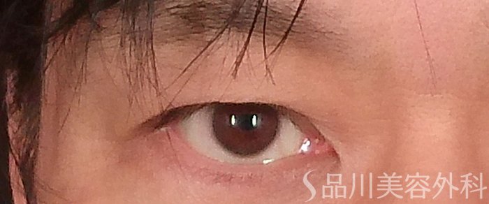 症例NO.69360のBEFORE写真