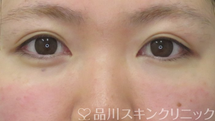 症例NO.71171のAFTER写真