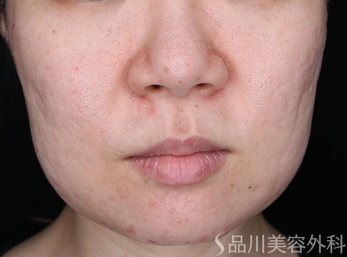 症例NO.74383のBEFORE写真