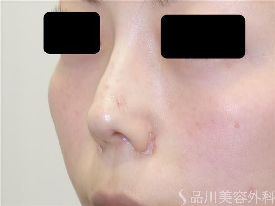 症例NO.42594のAFTER写真