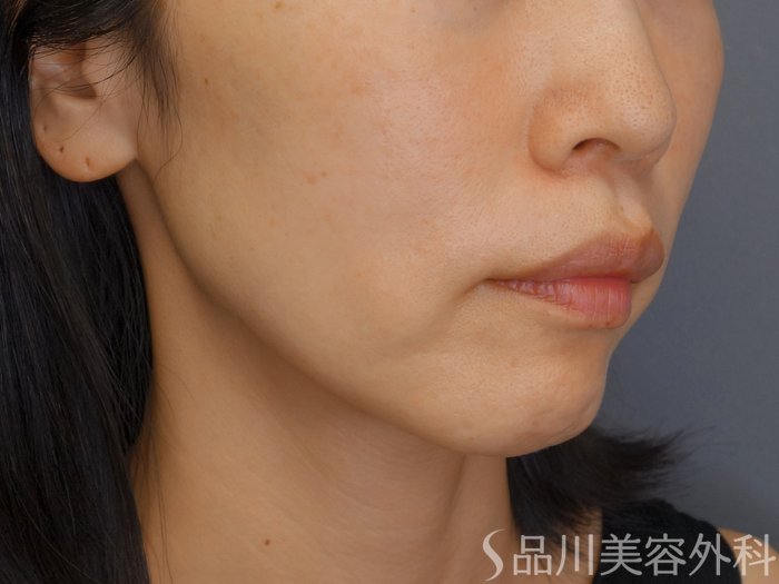 症例NO.72059のBEFORE写真