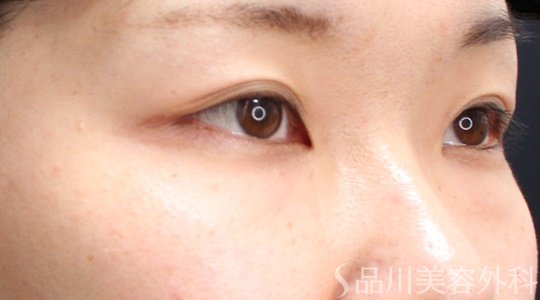 症例NO.69599のBEFORE写真