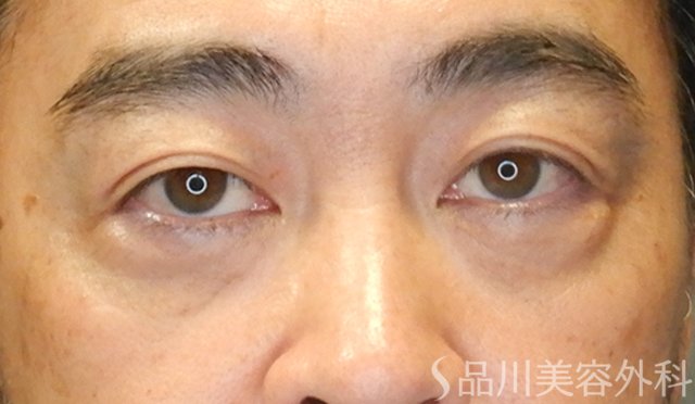 症例NO.65423のAFTER写真
