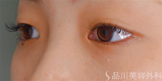 症例NO.56052のBEFORE写真