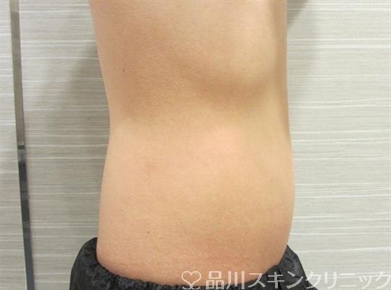 症例NO.33132のAFTER写真