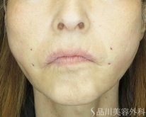 症例NO.75300のAFTER写真