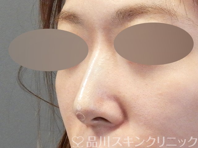 症例NO.64935のAFTER写真