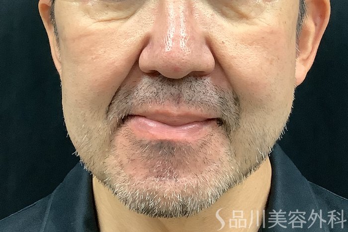 症例NO.71246のBEFORE写真