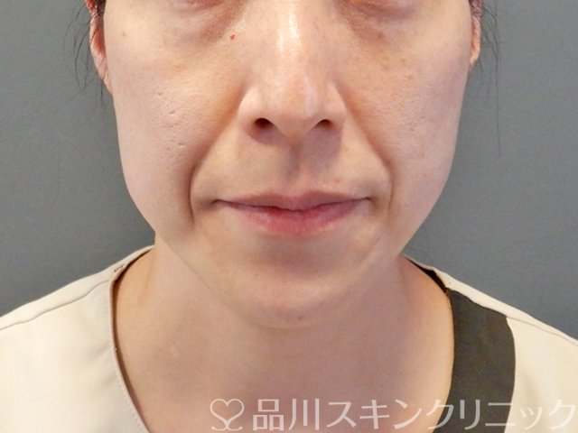 症例NO.68460のBEFORE写真