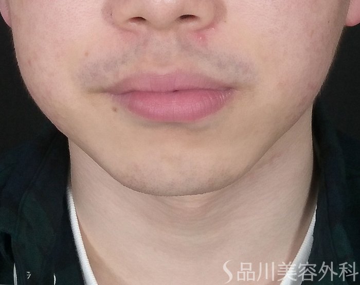 症例NO.69441のBEFORE写真