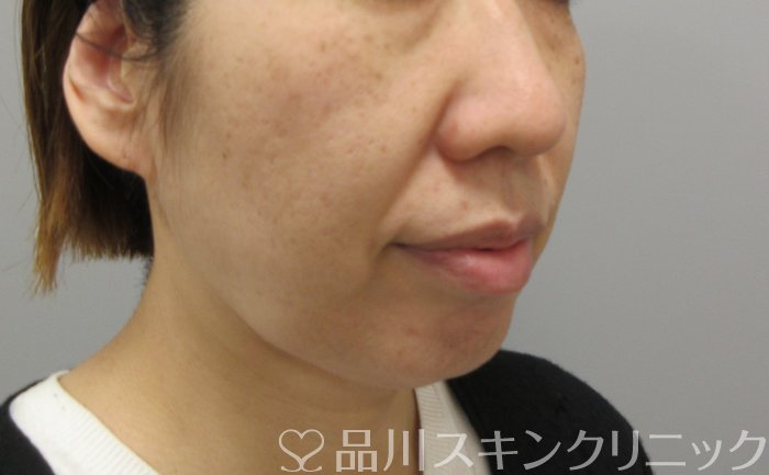 症例NO.70003のBEFORE写真