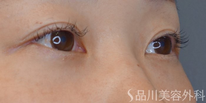 症例NO.71737のBEFORE写真