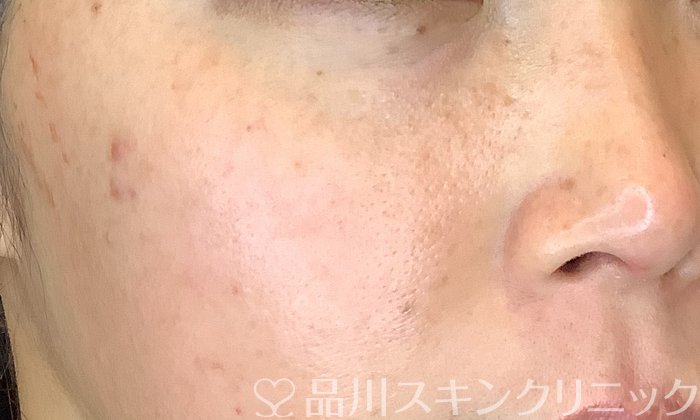 症例NO.72794のBEFORE写真