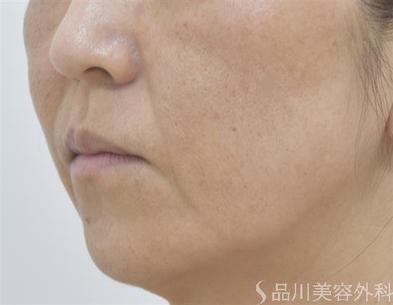 症例NO.46599のBEFORE写真