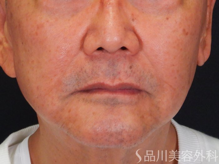 症例NO.68008のAFTER写真
