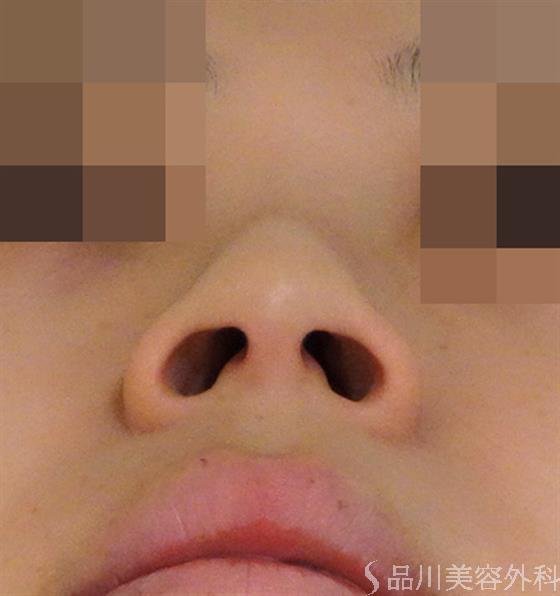 症例NO.44654のBEFORE写真