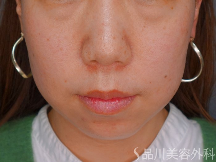 症例NO.73793のBEFORE写真