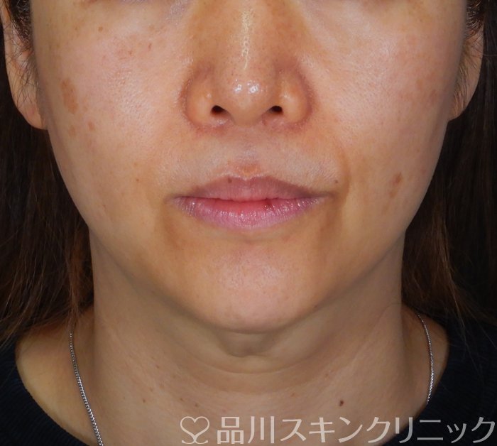 症例NO.65906のBEFORE写真