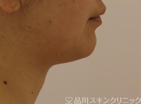 症例NO.43986のAFTER写真