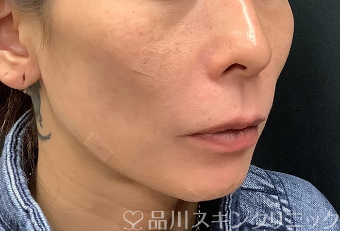 症例NO.69485のBEFORE写真