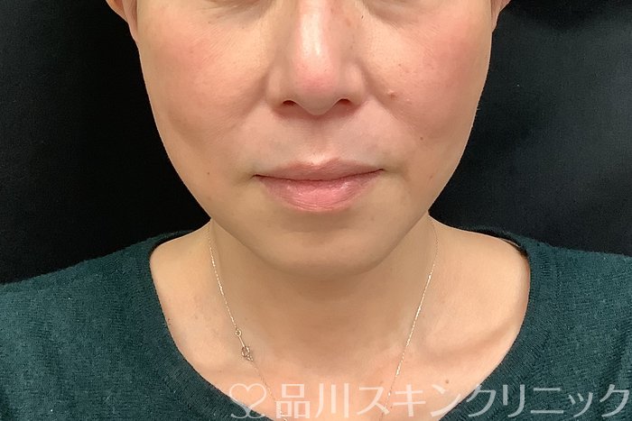 症例NO.71293のAFTER写真