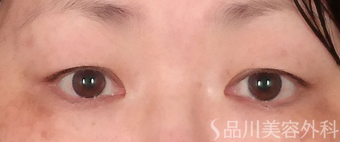 症例NO.71348のBEFORE写真
