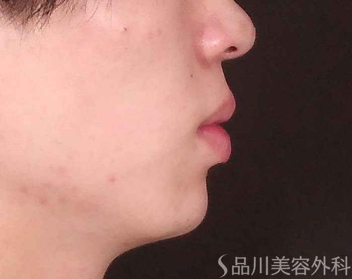 症例NO.70093のAFTER写真