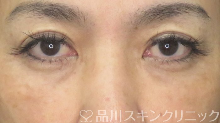 症例NO.71982のBEFORE写真