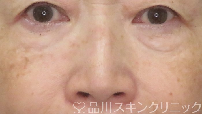症例NO.71558のBEFORE写真