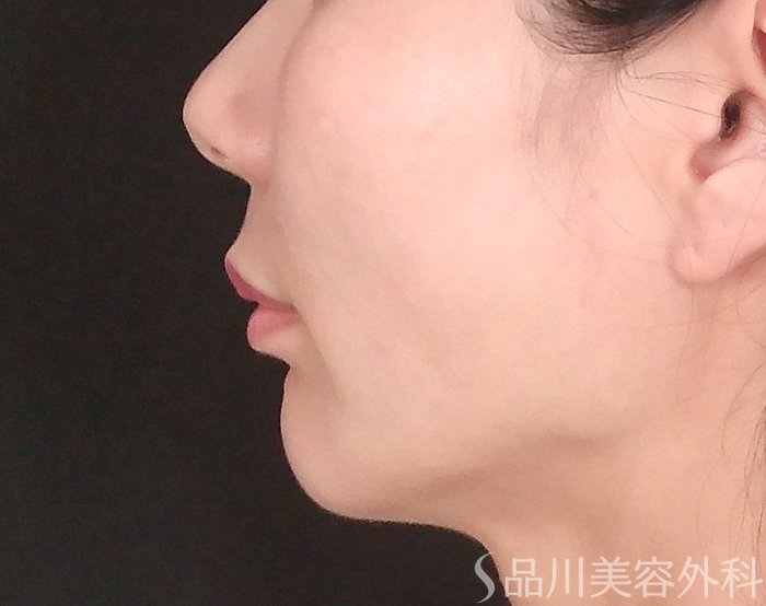 症例NO.69721のBEFORE写真