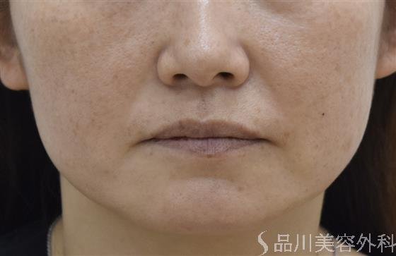 症例NO.44024のBEFORE写真