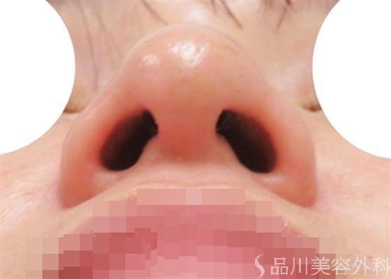 症例NO.51165のBEFORE写真