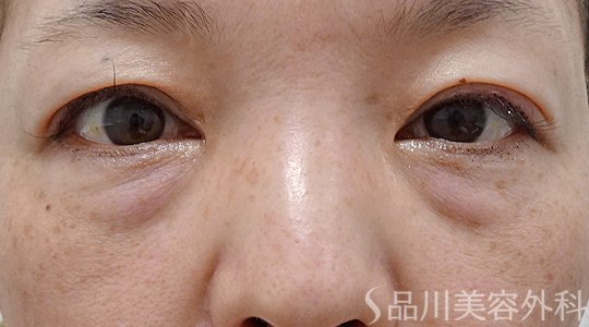 症例NO.62927のBEFORE写真