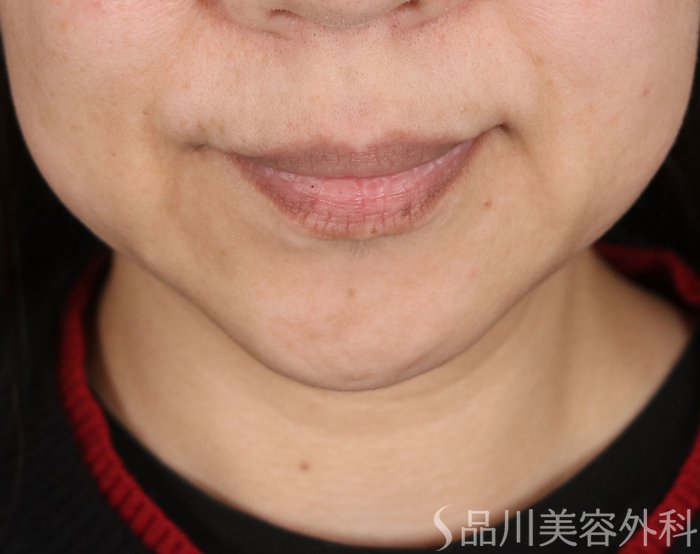 症例NO.72245のBEFORE写真