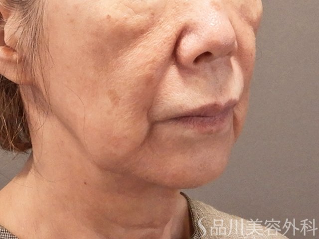 症例NO.73193のBEFORE写真