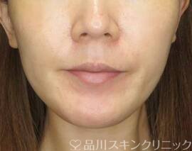 症例NO.72246のBEFORE写真