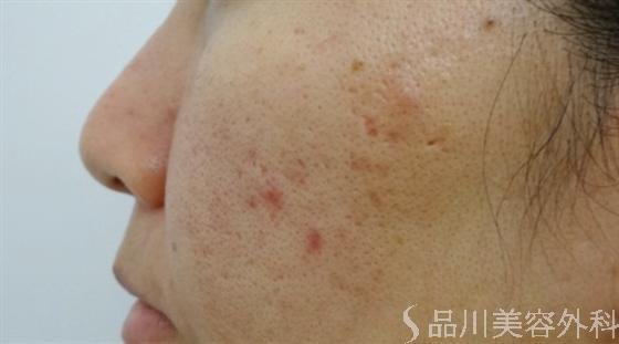症例NO.17597のBEFORE写真