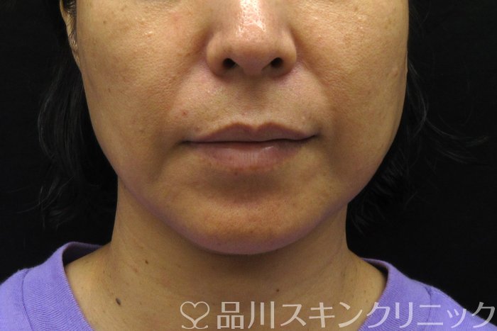 症例NO.74807のBEFORE写真