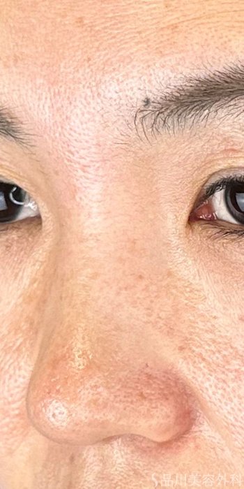 症例NO.70650のBEFORE写真