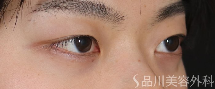 症例NO.73789のBEFORE写真