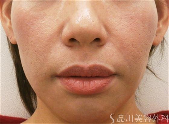 症例NO.18768のBEFORE写真