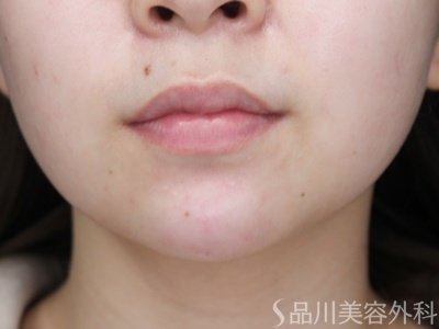 症例NO.69966のAFTER写真