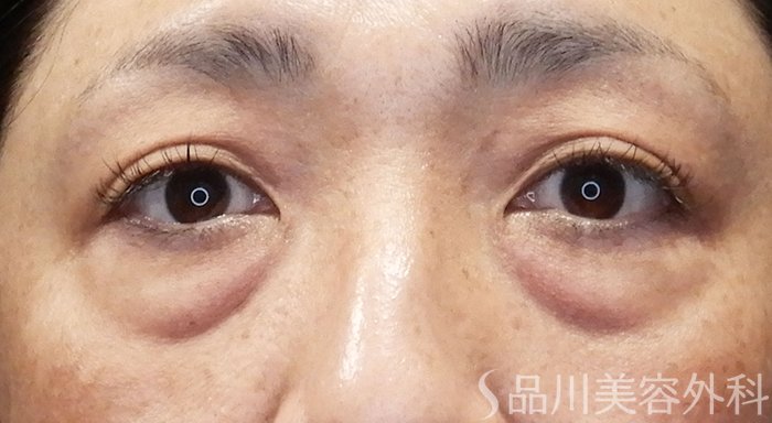 症例NO.70095のBEFORE写真