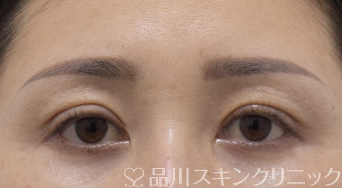 症例NO.75017のAFTER写真