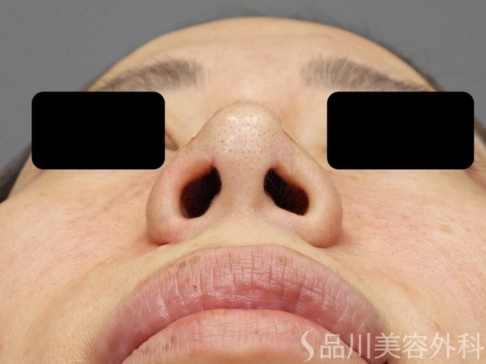 症例NO.72538のAFTER写真